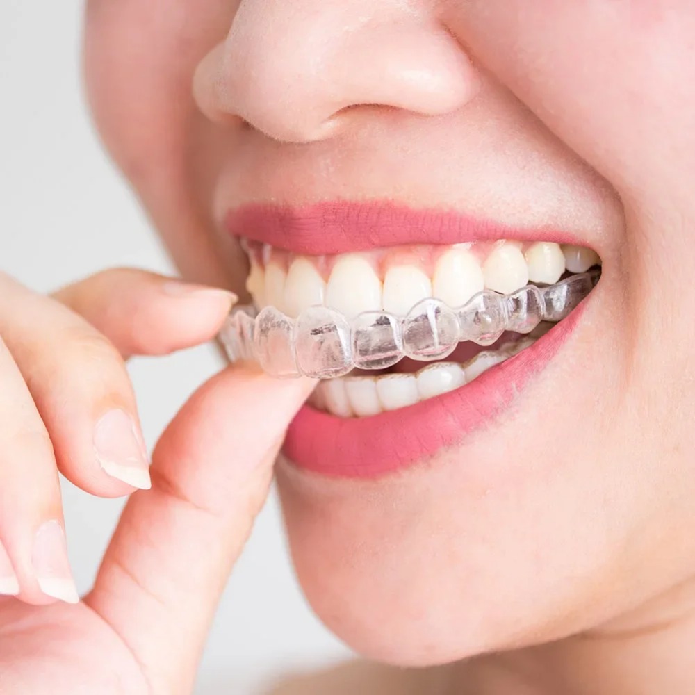 Dental Guard Night - 1-4 Stück Anti-Schnarch- und Bruxismus-Schlafmundschutz, Zahnschutz