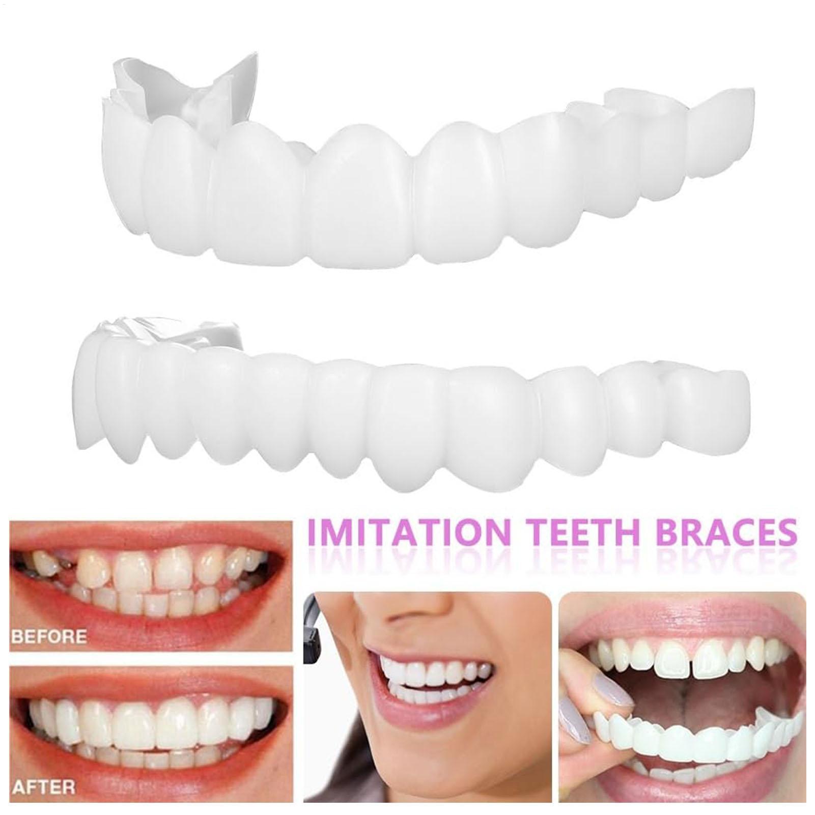 Teeth Whitening With Braces - Zahnprothesen für Ober- und Unterkiefer: Helle