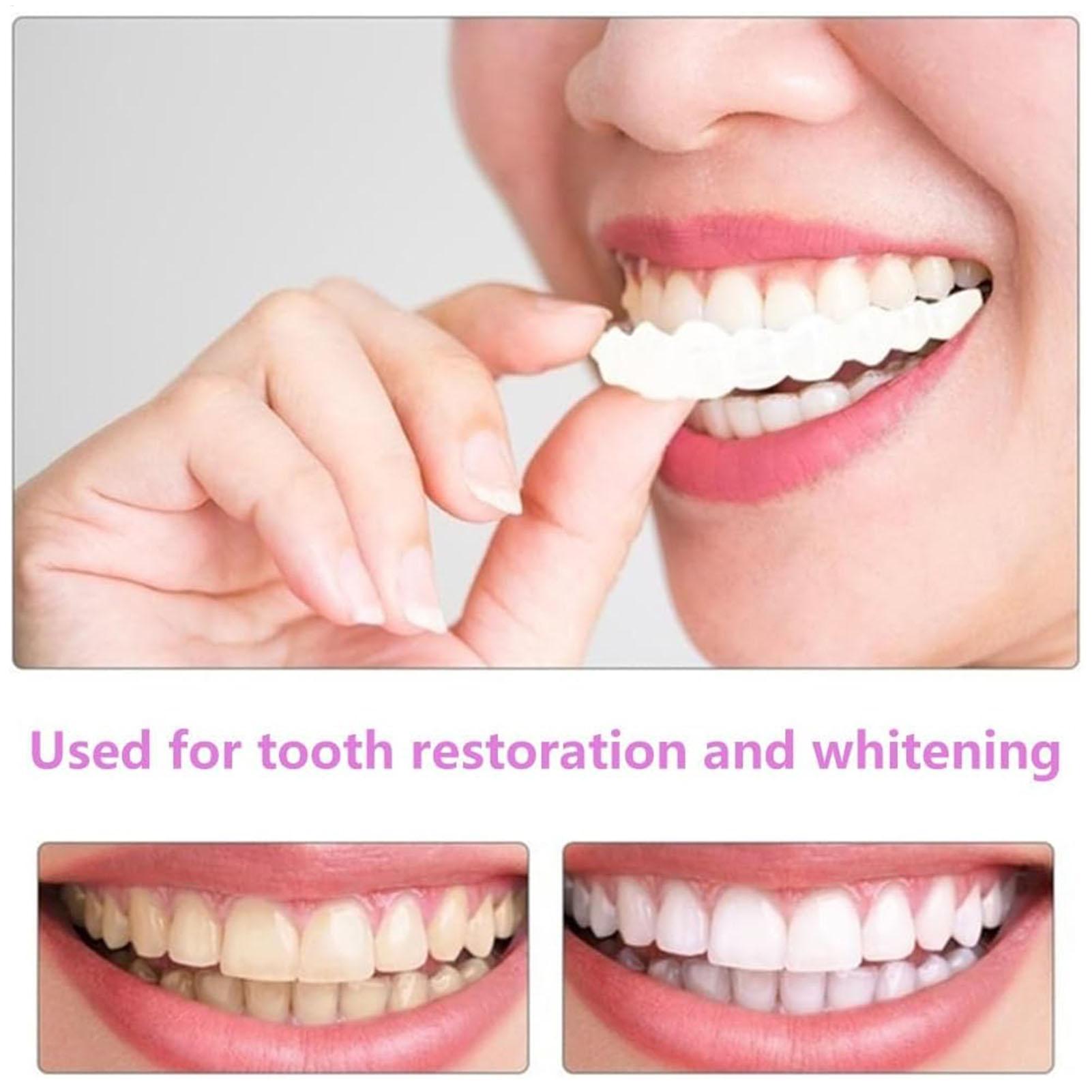 Zahnprothesen für Ober- und Un – Teeth Whitening With Braces Bewertung und Preis