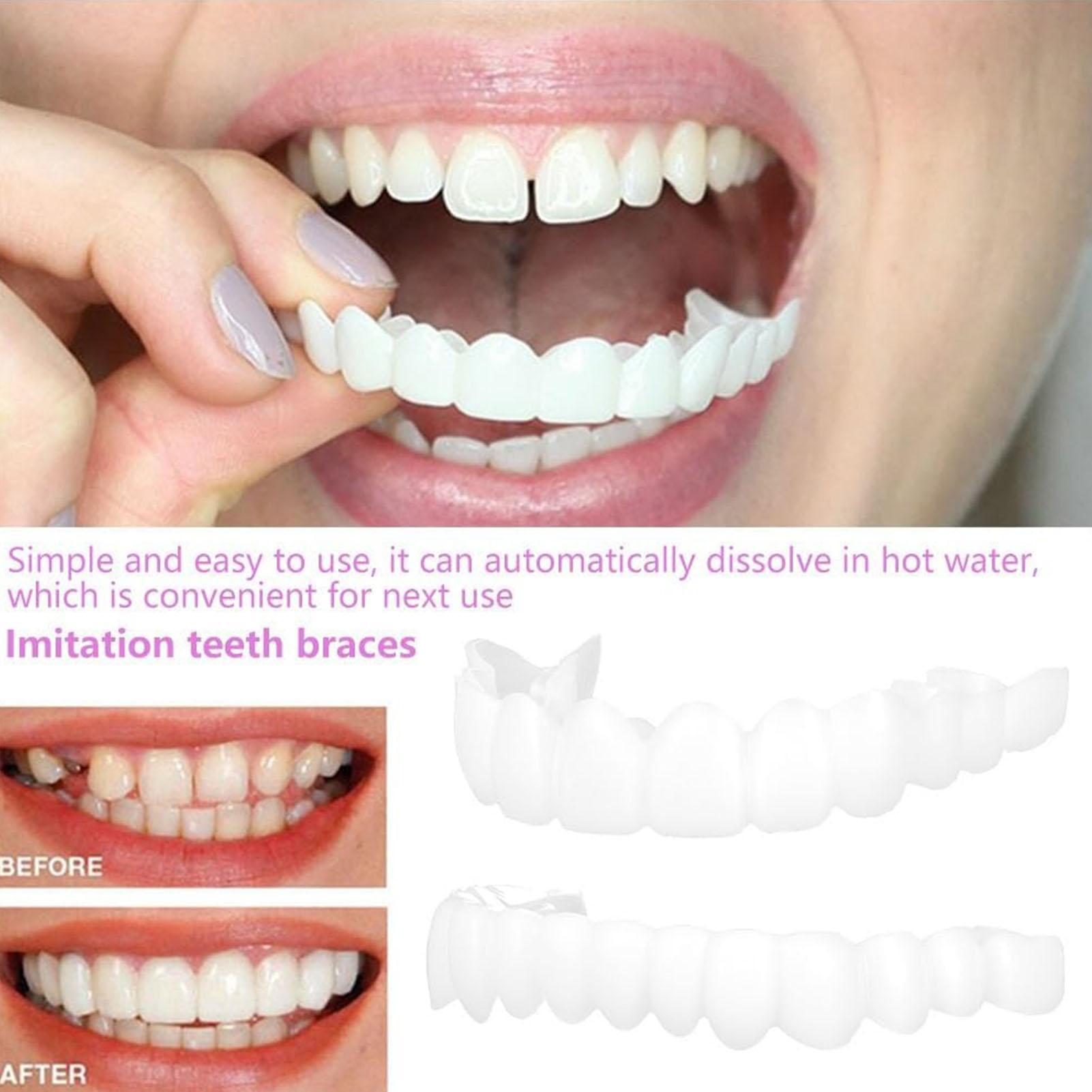 Zahnprothesen für Ober- und Un – Teeth Whitening With Braces Bewertung und Preis