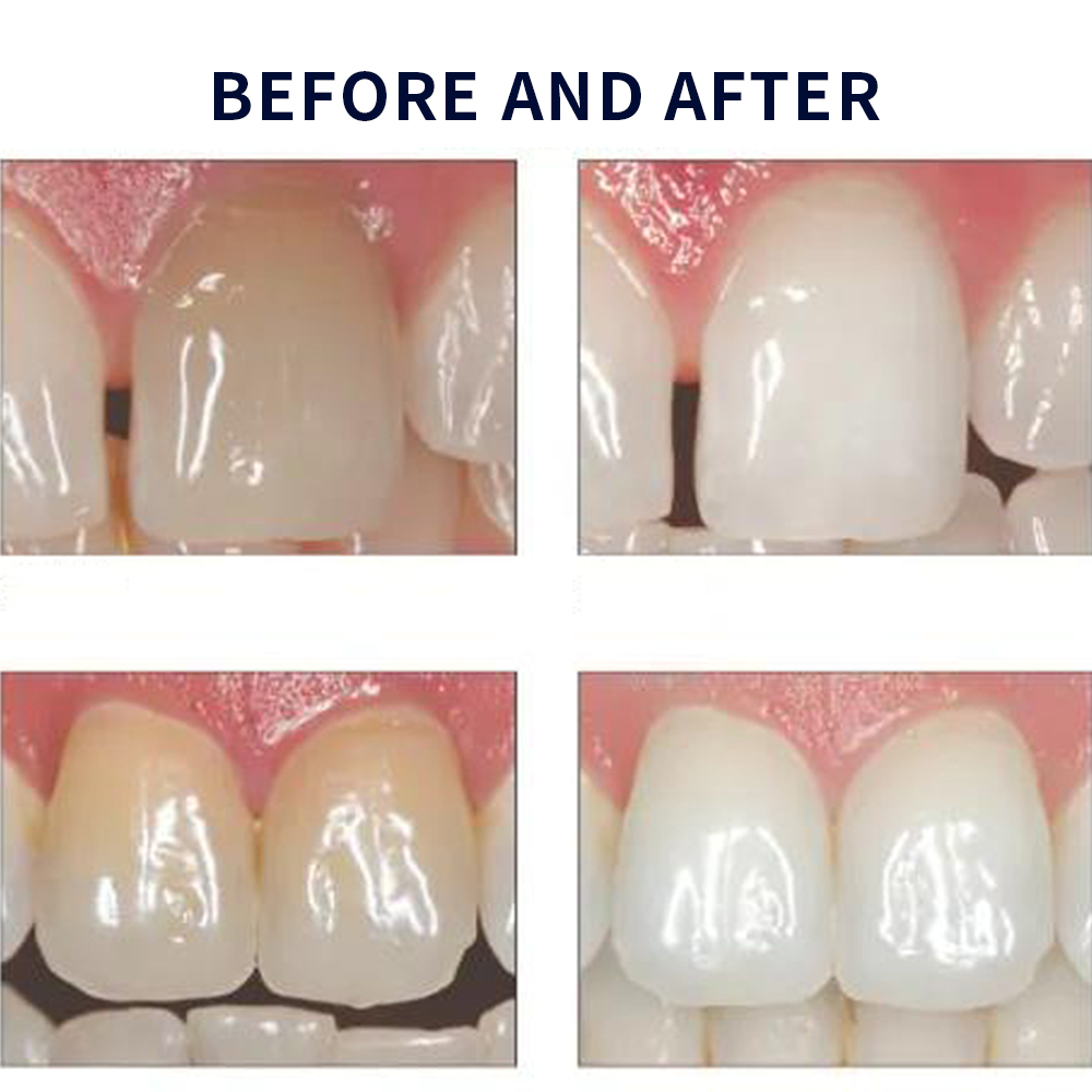 Opale scence White ning 1,2 pf – Teeth Whitening Price Bewertung und Preis