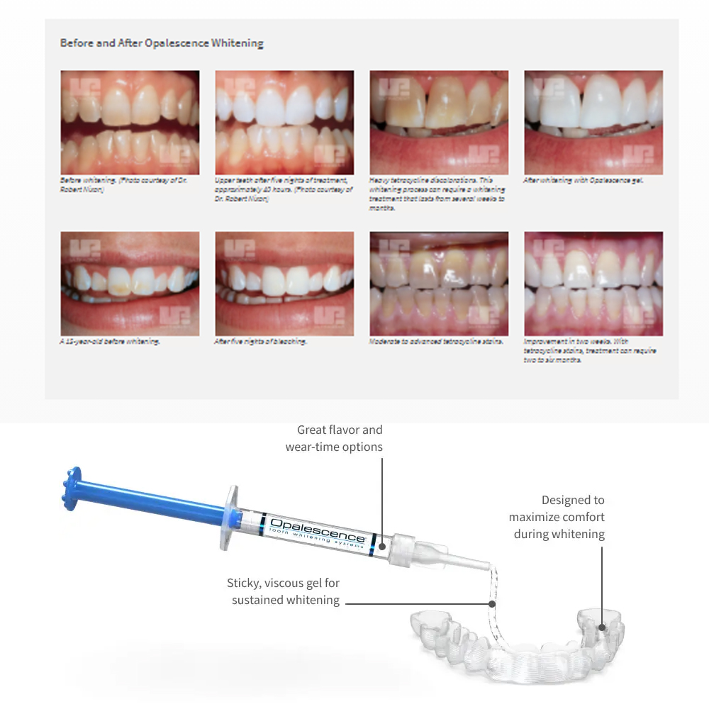 Opale scence White ning 1,2 pf – Teeth Whitening Price Bewertung und Preis