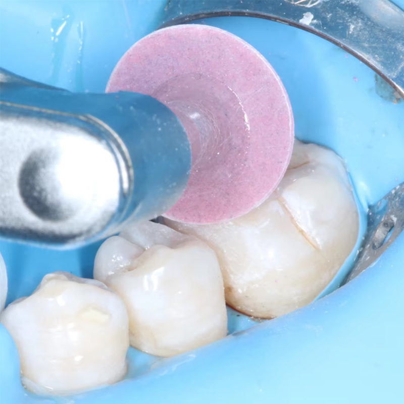 40 Stück Dental-Polierscheiben – Teeth Whitening Uk Bewertung und Preis