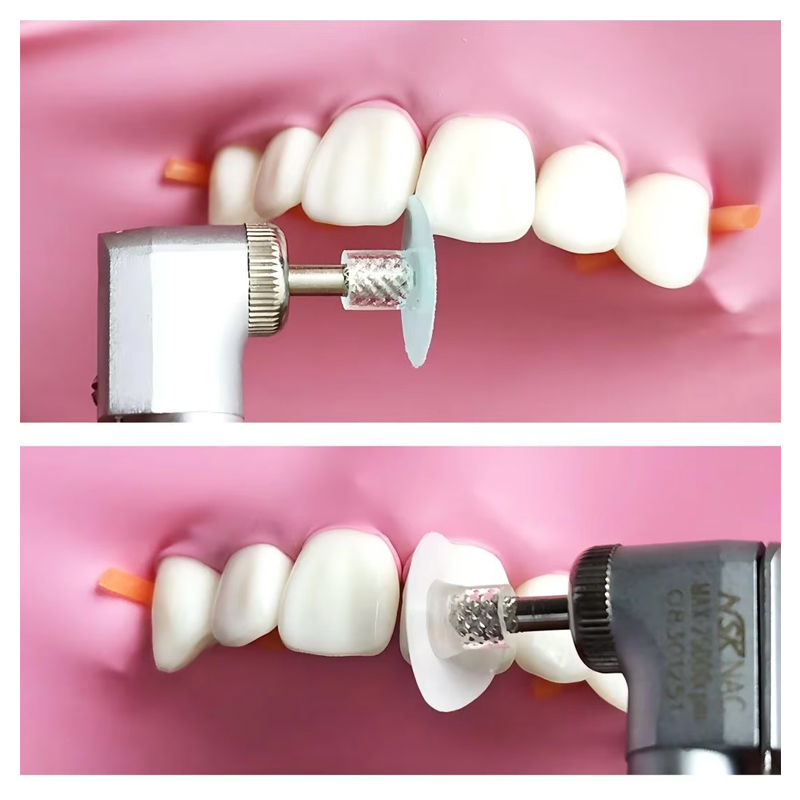 40 Stück Dental-Polierscheiben – Teeth Whitening Uk Bewertung und Preis