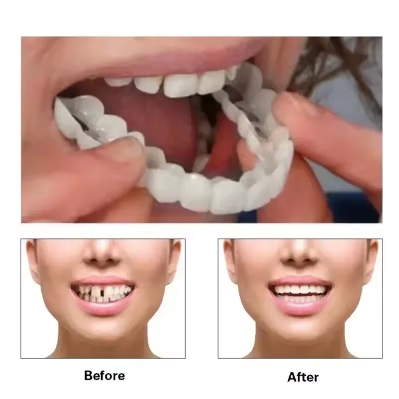 Zahn-Veneers Zahnaufhellung Za – Teeth Whitening With Braces Bewertung und Preis