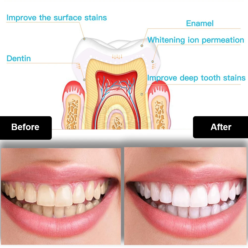 Dental Zahnaufhellung Kit Mini – Teeth Whitening Price Bewertung und Preis