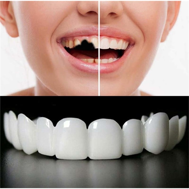 [NEU! ABMK】 2 Paar, Wiederhers – Teeth Whitening With Braces Bewertung und Preis