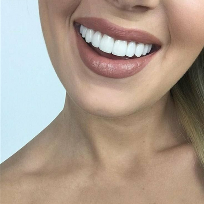 On Smile Dental Ober- und Unte – Teeth Whitening With Braces Bewertung und Preis